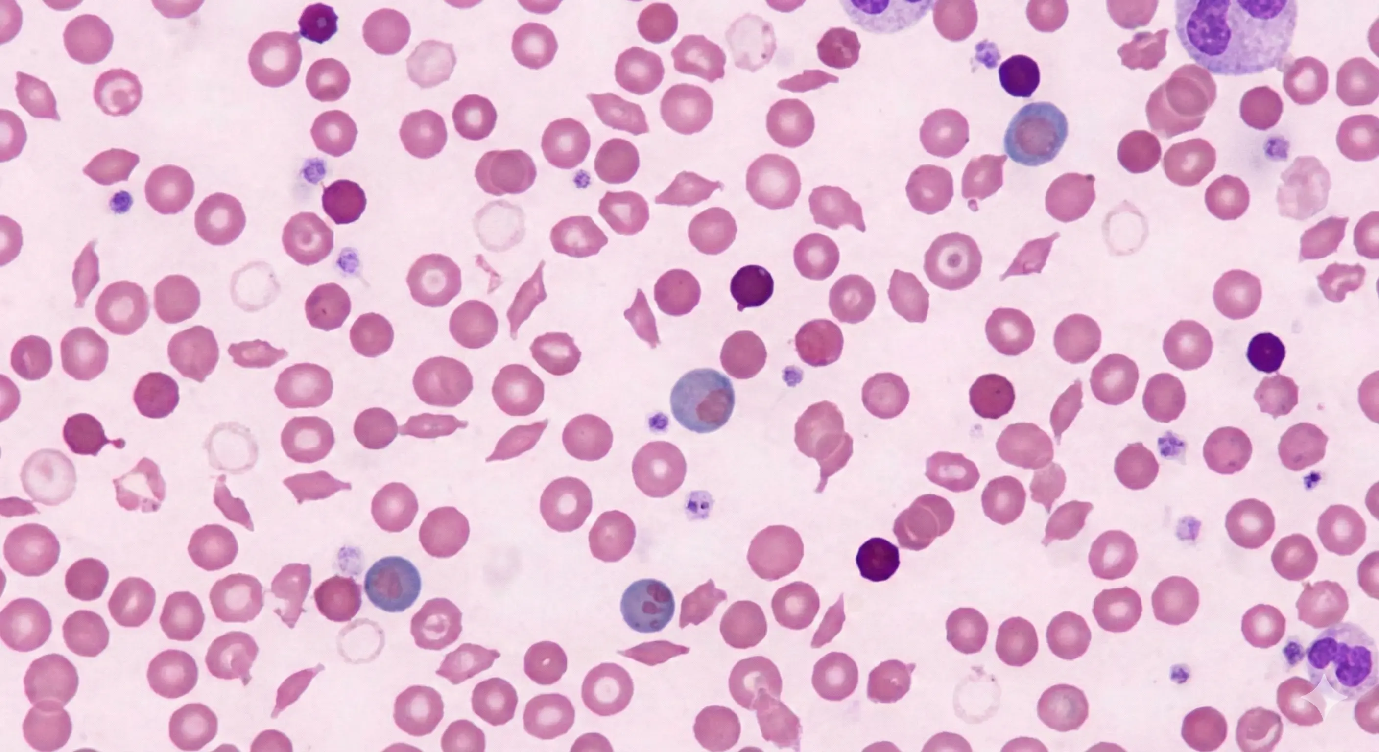 Hemolytic Disorders
