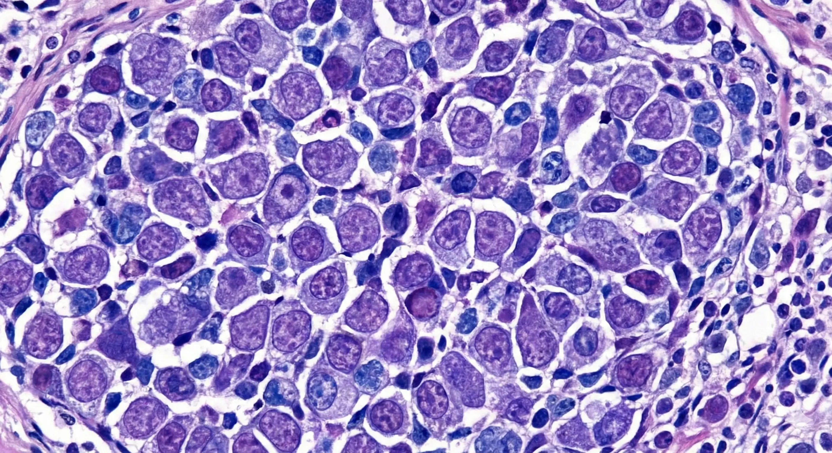 Lymphoma disorders