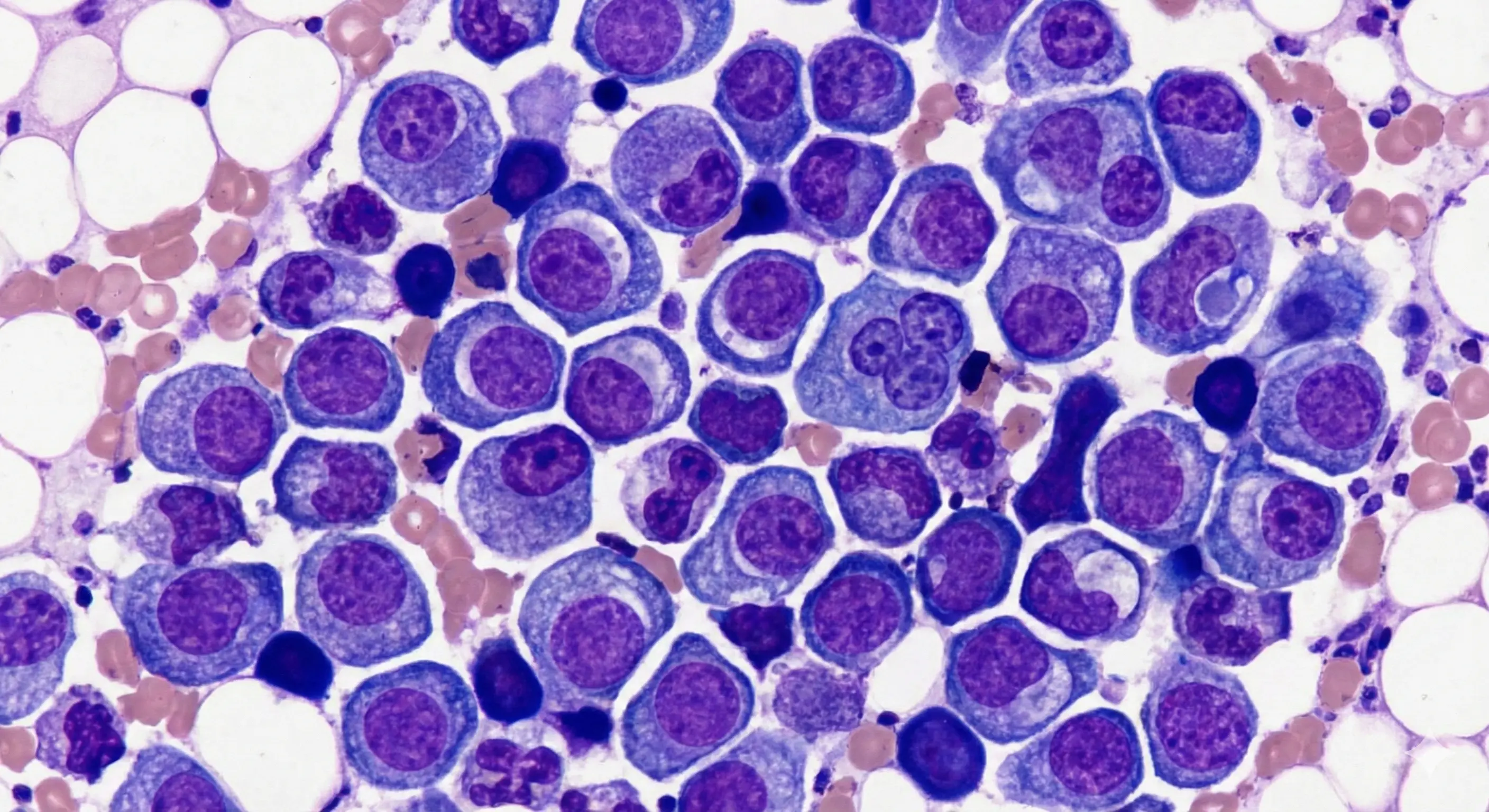 Myeloma disorders